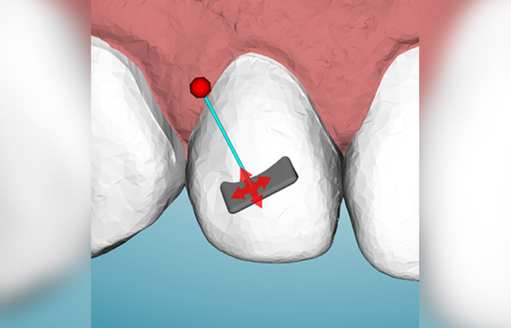 Placing attachments