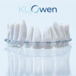 KLOwen Full Custom Solution