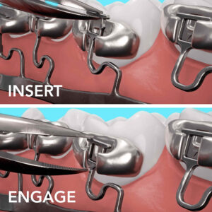 BRAVA insert engage image