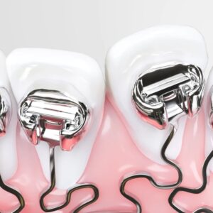 Brackets in the mouth