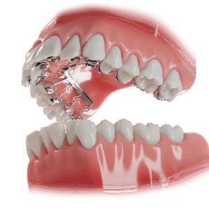 Brava braces hidden upper visible